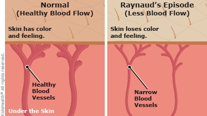 Diagram showing fingers of a child with Raynaud's syndrome as described in the article. One finger has normal blood vessels under skin with healthy color. Another finger has narrow blood vessels under pale skin on the fingertip.