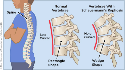 Illustration showing how the vertebrae with Scheuermanns disease is more curved than normal vertebrae.