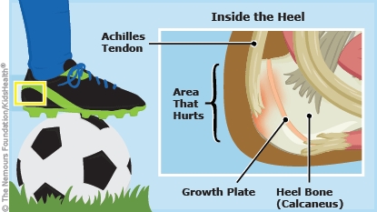 Diagram labels inside the heel, muscle, heel bone, growth plate, tendon, heel bone, and area that hurts