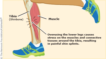 Diagram labels the shinbone, muscle, and painful area on the shin. Running, jumping, basketball, football, soccer, and dancing can lead to shinsplints.