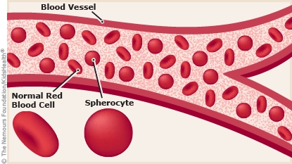Diagram showing a normal red blood cell shaped like a disc. The diagram also shows a red blood cell in someone who has hereditary spherocytosis. This blood cell is shaped like a sphere