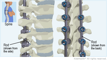 how spinal fusion surgery works