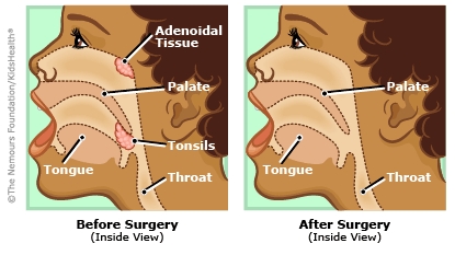 adenoidectomy illustration