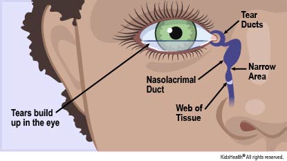 tear duct obstruction illustration