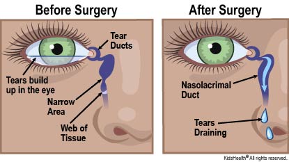 Diagram showing location of the tear duct, or nasolacrimal duct. The diagram shows that when the duct is blocked by a web of tissue, tears can’t drain and they build up in the eye. When the blockage is removed by surgery, the tears can drain.