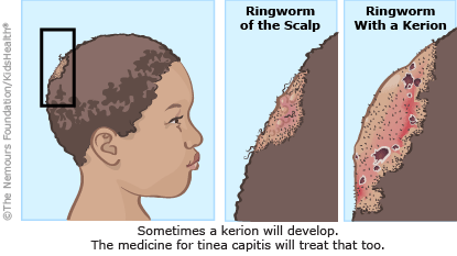 tinea capitis illustration