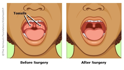 "Tonsillectomy