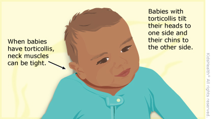 Picture shows how a baby with tight neck muscles from torticollis turns the head to one side