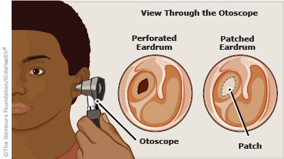 View of a perforated eardrum and a patched eardrum after a tympanoplasty.