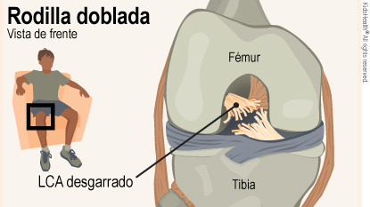 El diagrama muestra el fémur, la tibia y el LCA roto con la rodilla doblada.
