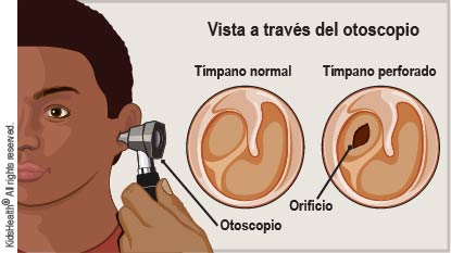 Vista de un tímpano normal y de un tímpano perforado