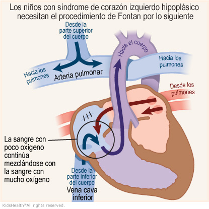 Illustration: A child with HLHS needs the Fontan procedure because