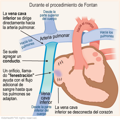 Illustration: During the Fontan Procedure