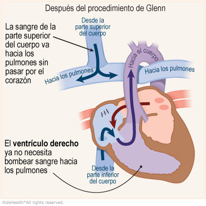 Illustration: How blood flows after the Glenn Procedure