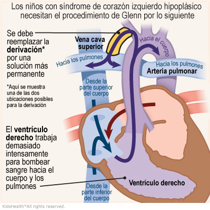 Illustration: A Child with HLHS needs the Glenn Procedure because