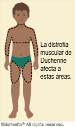 llustration: Areas affected by Duchenne muscular dystrophy