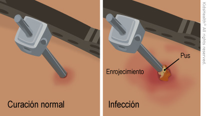 Illustration: External fixator pin site infection
