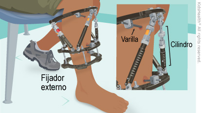 Illustration: external fixator close up