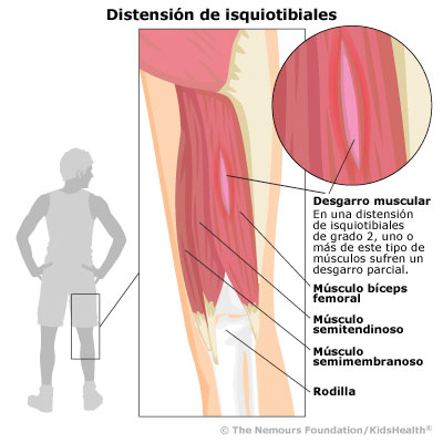 Distension de isquiotibiales