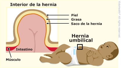 La ilustración muestra a un bebé con una hernia umbilical y el interior de la hernia.