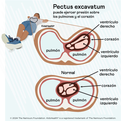 Illustration: Pectus excavatum pressure on heart and lungs