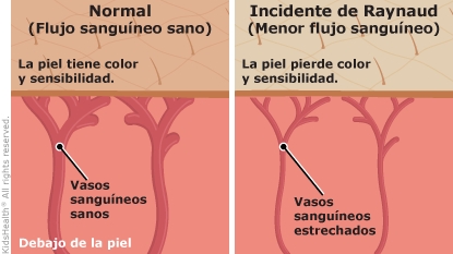 Ilustración que muestra los dedos de la mano de un niño con síndrome de Raynaud, como se describe en el artículo. Un dedo tiene vasos sanguíneos normales debajo de la piel con un color normal. El otro dedo tiene la punta de los dedos con vasos sanguíneos estrechos debajo de una piel pálida.