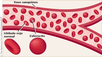 Ilustración que muestra un glóbulo rojo normal con forma de disco. La ilustración también muestra el glóbulo rojo de una persona con esferocitosis hereditaria, el cual tiene la forma de una esfera.